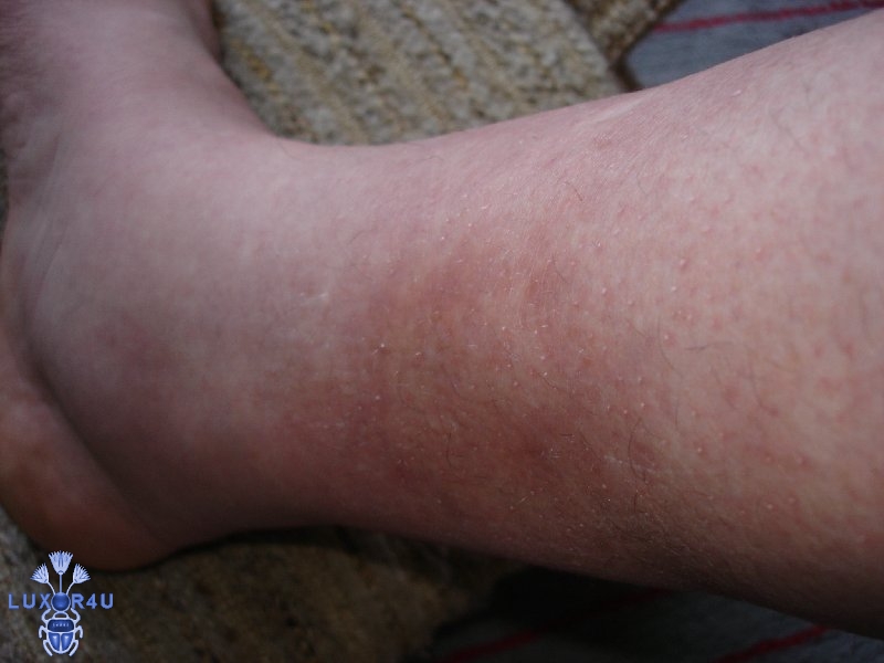 bruises
