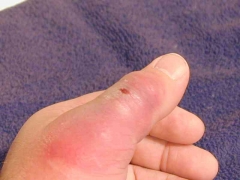spider bite 1